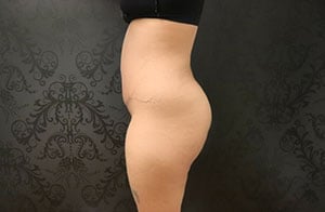 Tummy Tuck