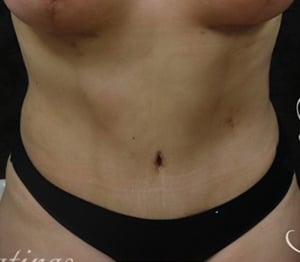 Tummy Tuck
