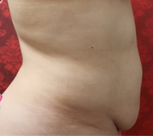 Tummy Tuck