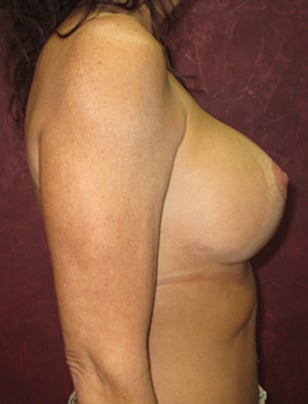 Breast Augmentation