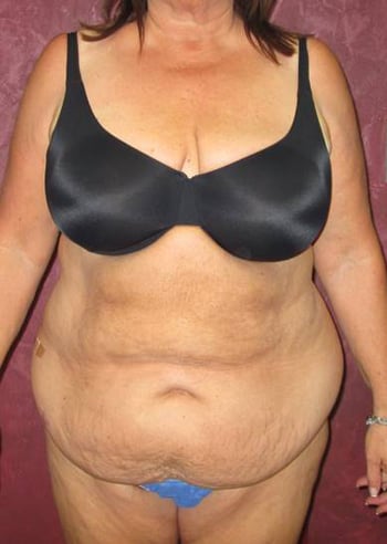 Tummy Tuck