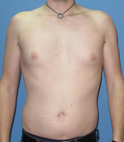 Liposuction