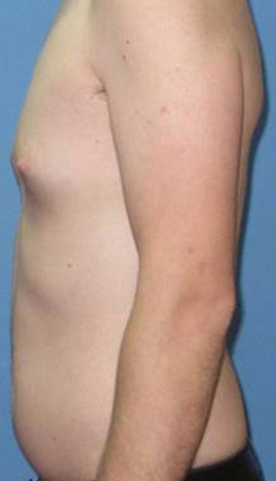 Liposuction