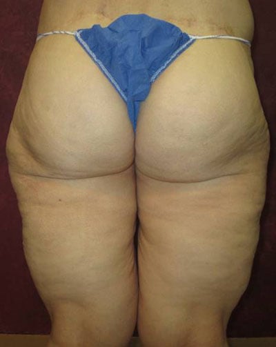 Thigh Lift