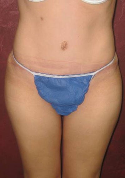 Tummy Tuck