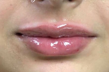 Lip Augmentation
