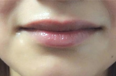 Lip Augmentation