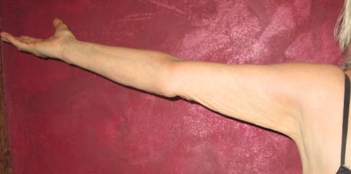 Arm Lift