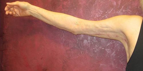 Arm Lift