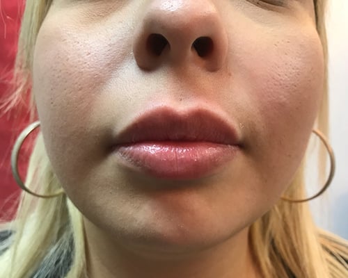 Lip Augmentation
