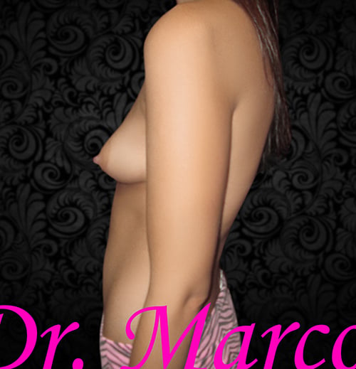 Breast Augmentation
