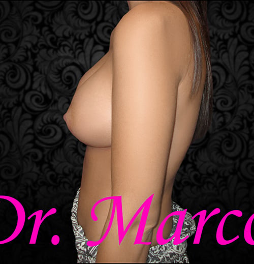 Breast Augmentation