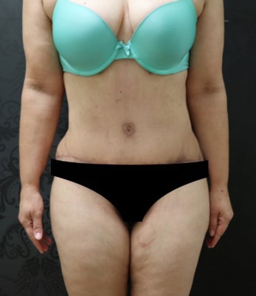 Tummy Tuck