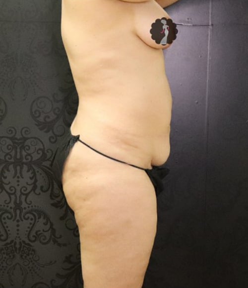 Tummy Tuck