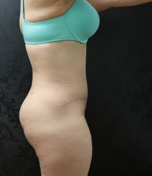 Tummy Tuck