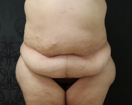 Tummy Tuck