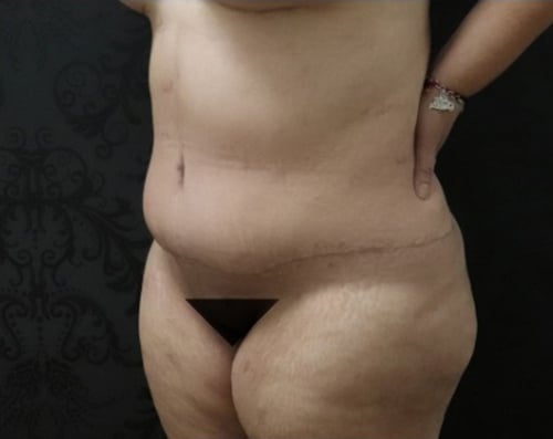 Tummy Tuck