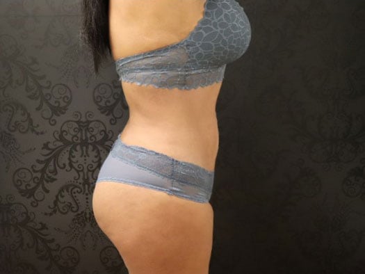 Liposuction