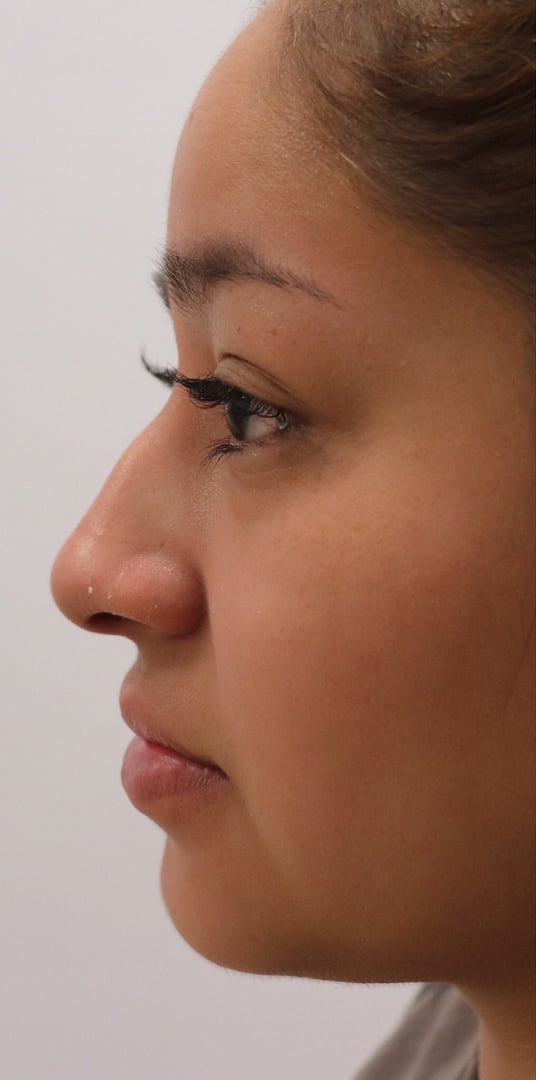 Non-Surgical Rhinoplasty