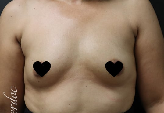 Breast Augmentation