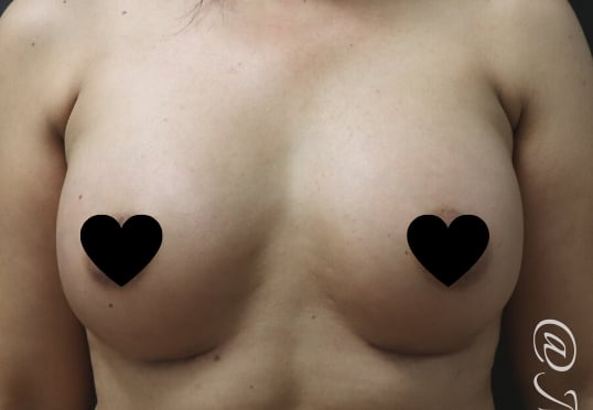 Breast Augmentation