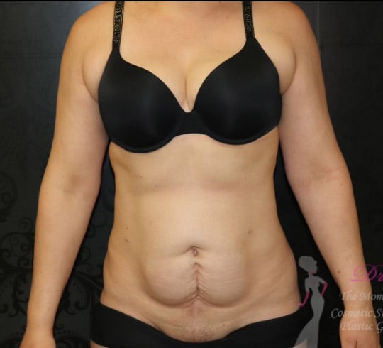 Liposuction