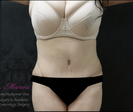 Liposuction