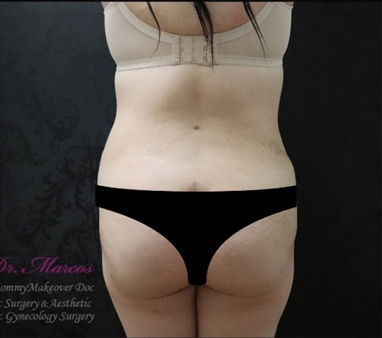 Liposuction