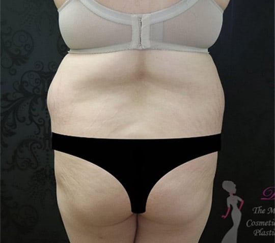 Liposuction
