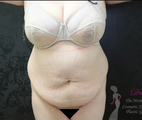 Liposuction