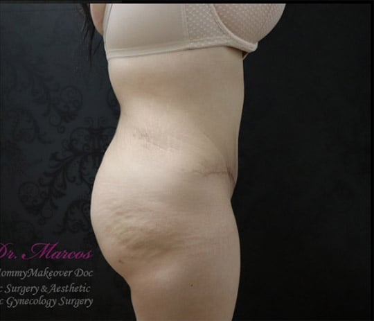 Liposuction