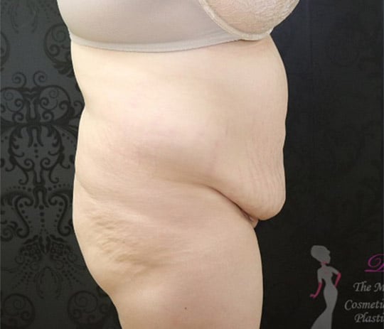Liposuction