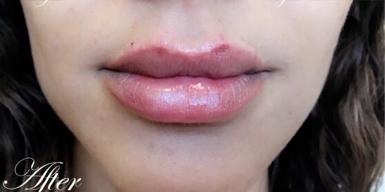 Lip Augmentation