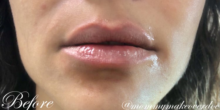 Lip Augmentation
